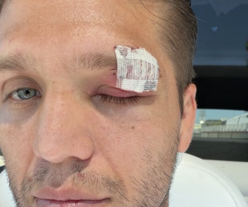 Brian Ortega Withdraws From UFC 331 Due to Eye Injury